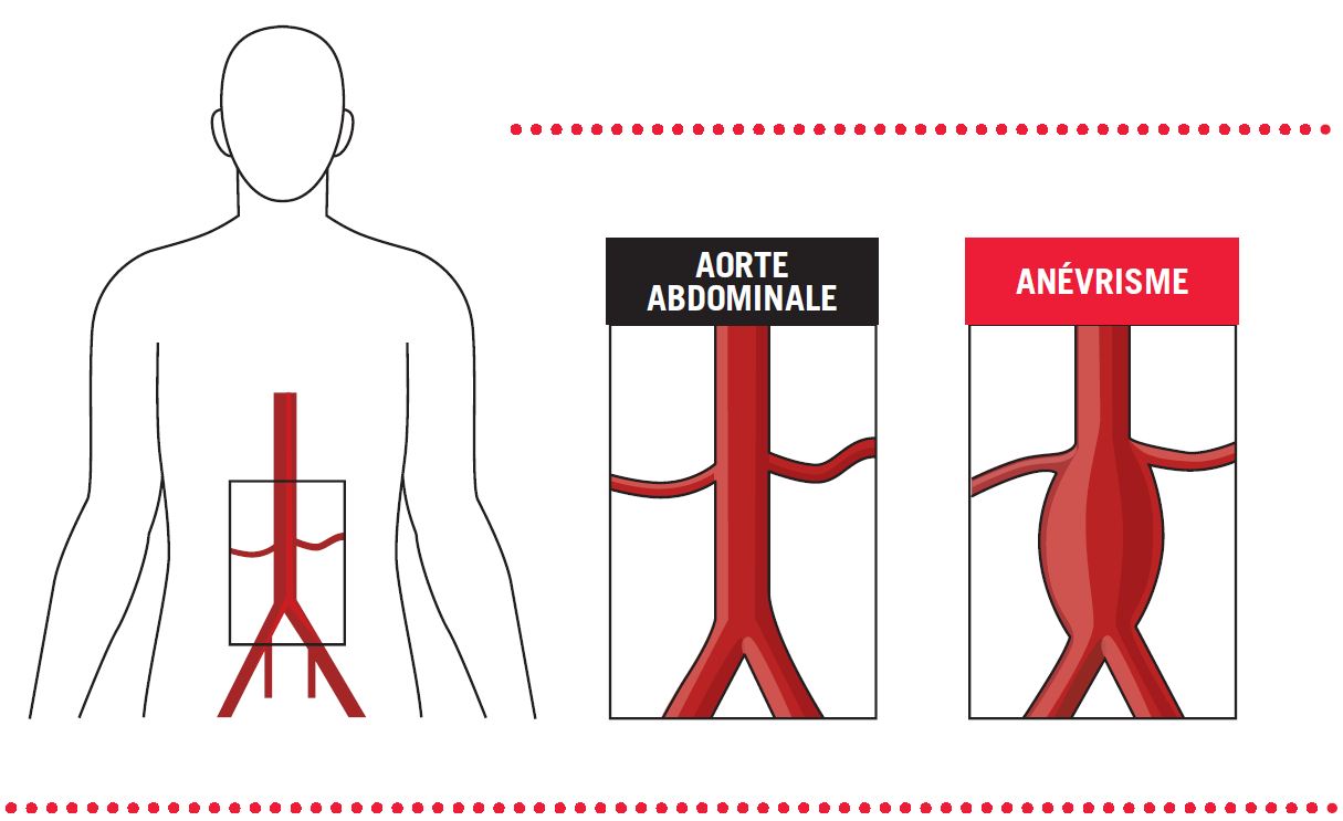 Anévrisme De L Aorte Esperance De Vie
